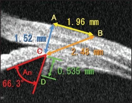 Ultrasound Bio microscopy (UBM)
