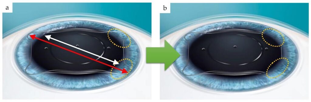 Phakic intraocular lens