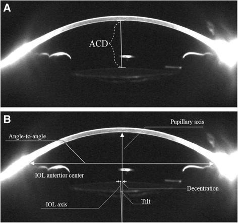 Corneal Tomography