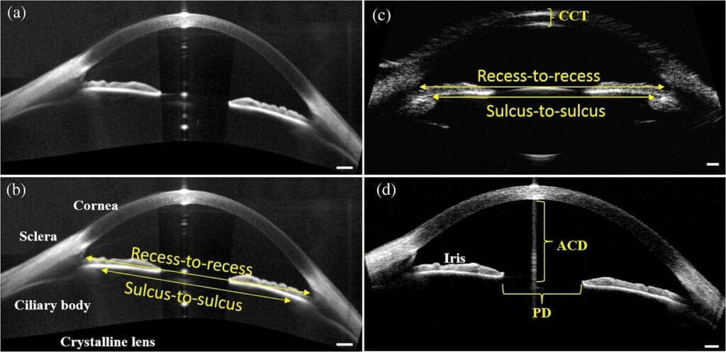 Sulcus-to-Sulcus (STS)
